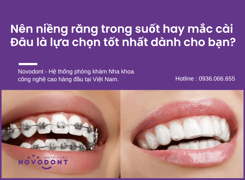 Nên niềng răng trong suốt hay mắc cài Đâu là lựa chọn tốt nhất dành cho bạn?