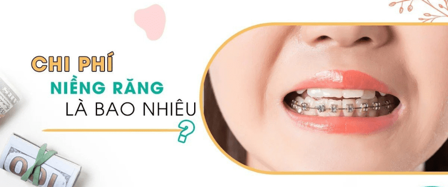 Chi phí niềng răng đúng chuẩn là bao nhiêu? Tùy thuộc vào chất lượng nha khoa và tình trạng sức khỏe răng miệng