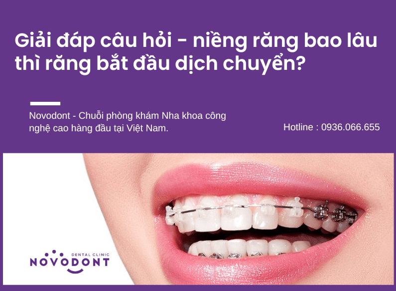 Giải đáp câu hỏi - niềng răng bao lâu thì răng bắt đầu dịch chuyển?