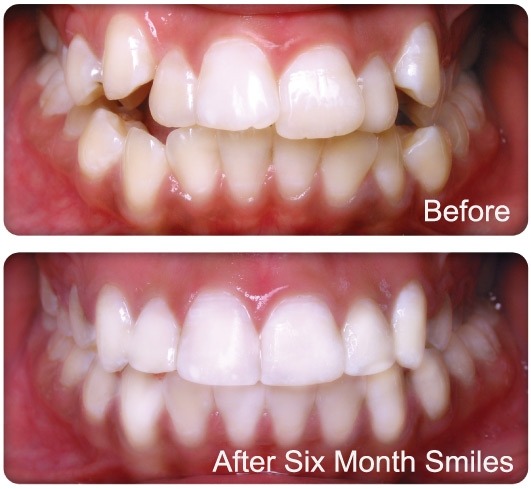 Niềng răng sau khoảng 6 tháng, răng dịch chuyển cân đối hơn 