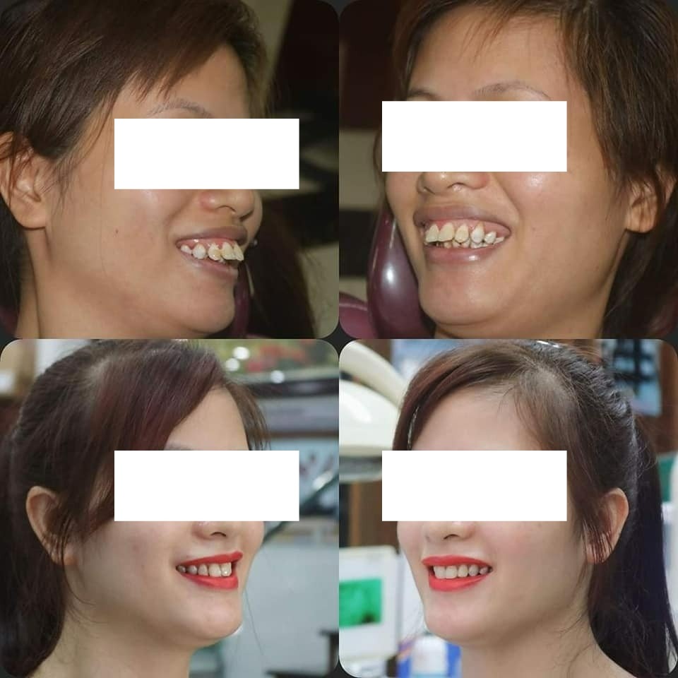  Răng vẩu của bệnh nhân được cải thiện 