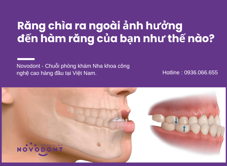 Răng chìa ra ngoài ảnh hưởng đến hàm răng của bạn