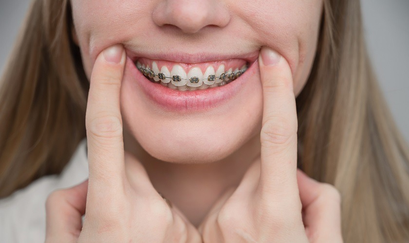 Niềng răng được xem như là quá trình cải thiện các vấn đề của răng một cách triệt để 