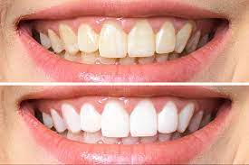 Tẩy trắng răng ố vàng đạt hiệu quả tốt khi được thực hiên tại nha khoa uy tín 