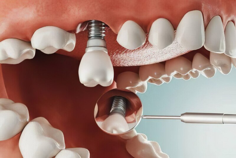Phương pháp trồng răng Implant giúp khôi phục hoàn toàn chức năng ăn nhai