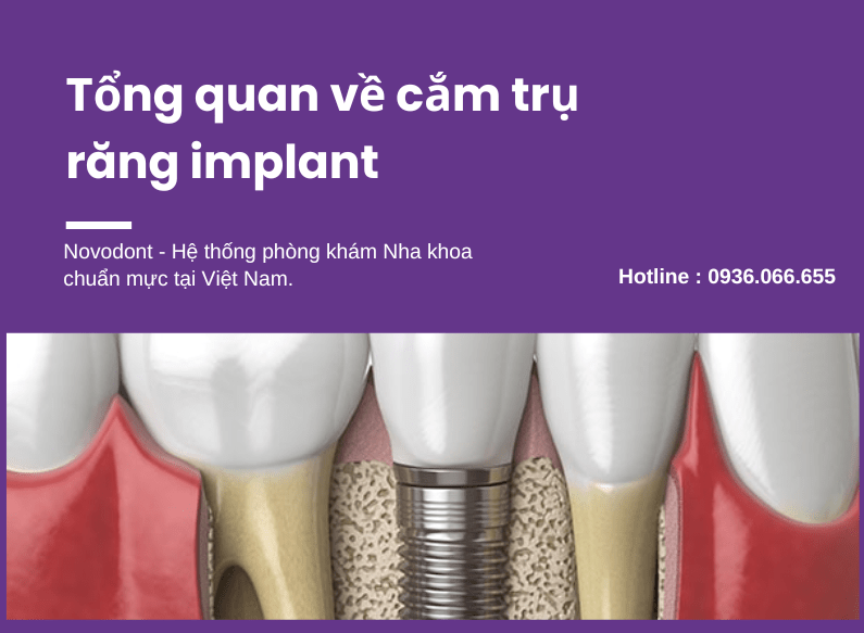 Tìm hiểu tổng quan về quá trình cắm trụ răng implant