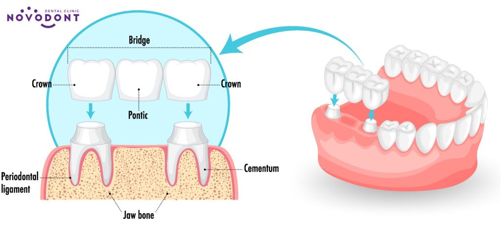 Mô hình của cầu răng sứ trên bản 3D 