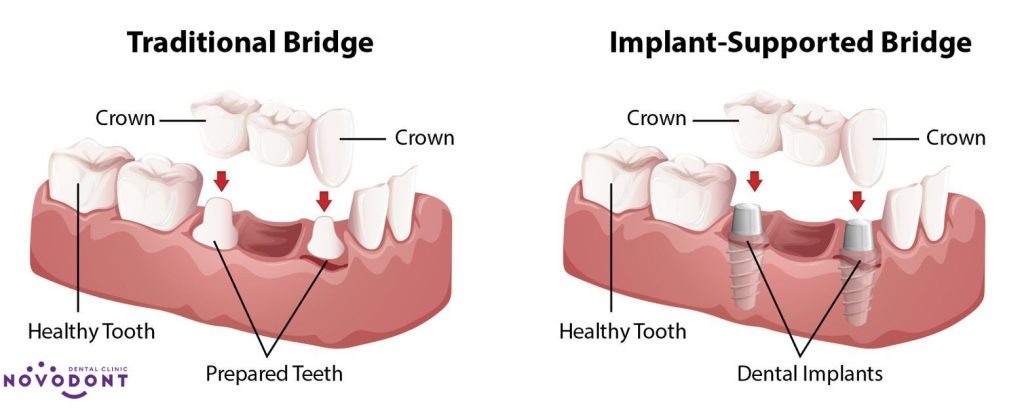 Giữa cầu răng sứ và trồng răng Implant có nhiều điểm khá tương đồng 