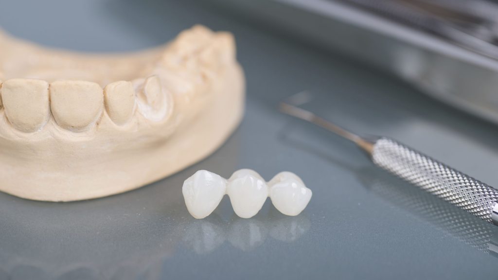 Cầu răng sứ thích hợp cho những trường hợp mất một hoặc vài chiếc răng, và các răng còn lại ở hai bên đều khá chắc khỏe