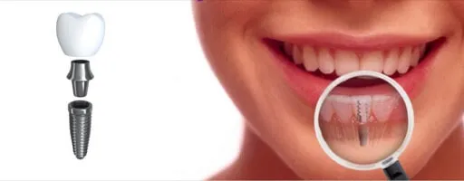 Có nên trồng răng implant không? Nên trồng răng implant khi bị mất răng