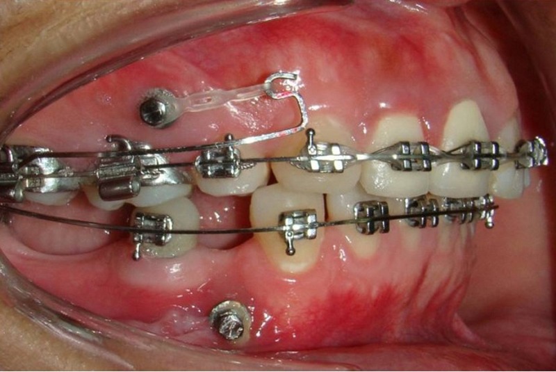 Hình ảnh giai đoạn đóng khoảng trong niềng răng