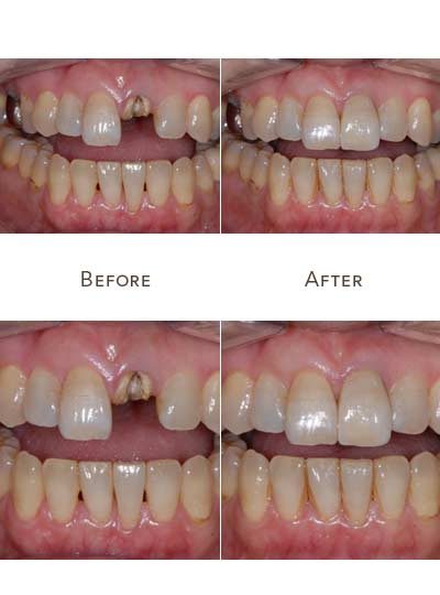  Hiệu quả rõ rệt sau khi cấy răng cửa bằng phương pháp Implant