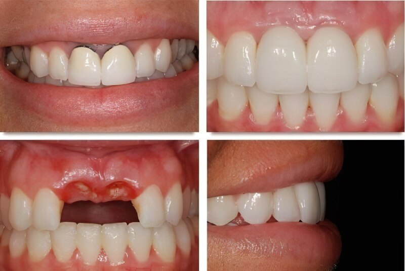 Hình ảnh sau khi trồng implant răng cửa