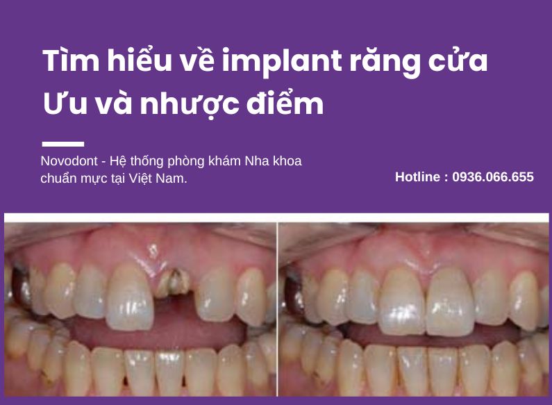 Implant răng cửa là phương pháp phục hình răng tối ưu nhất khi răng cửa bị mất, nứt hay sâu nặng