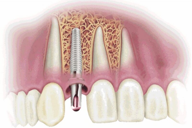 Mật độ xương (cơ địa của từng người) có ảnh hưởng tới tình trạng răng implant bị đào thải