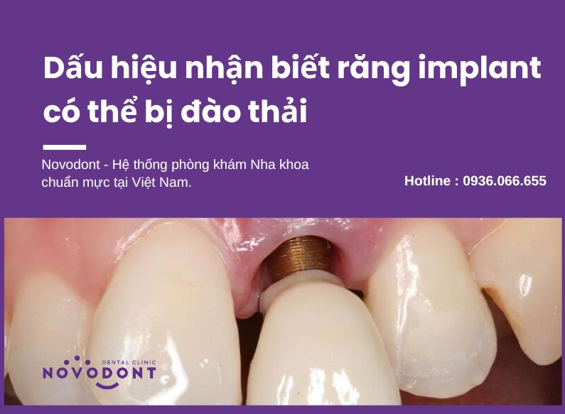 Lộ thân trụ implant là dấu hiệu rõ ràng răng implant bị đào thải