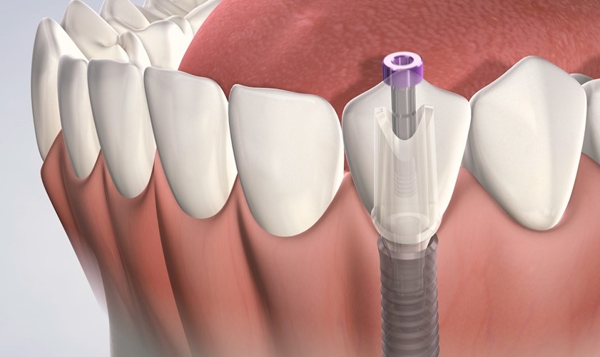Vô số những tổn thương có thể xảy ra khi việc trồng răng không đáp ứng yêu cầu kỹ thuật