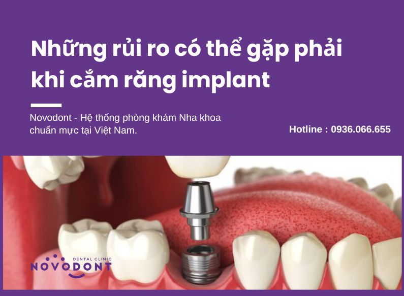 Trồng răng implant không phù hợp với mọi đối tượng