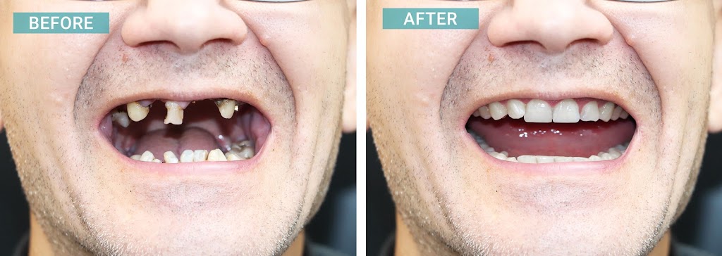 Trồng răng implant bao lâu thì lành? Hình ảnh trước và sau khi cấy ghép implant
