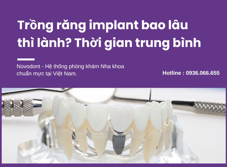Trồng răng implant bao lâu thì lành? Thời gian trung bình từ 2 tháng 