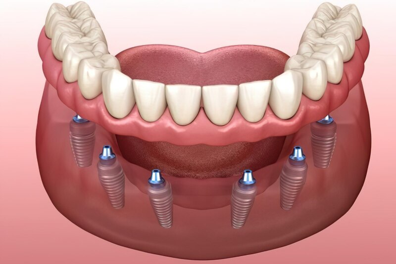 Trồng răng implant toàn hàm all on 6