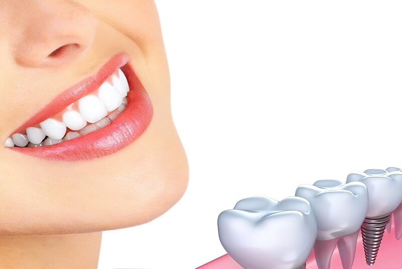 Trồng răng implant cải thiện thẩm mỹ và chức năng nhai khi bị mất, vỡ nhiều răng