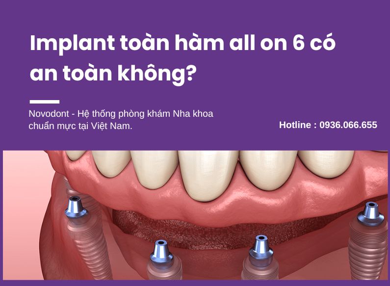 Trồng răng implant toàn hàm all on 4 hay all on 6 an toàn với răng miệng
