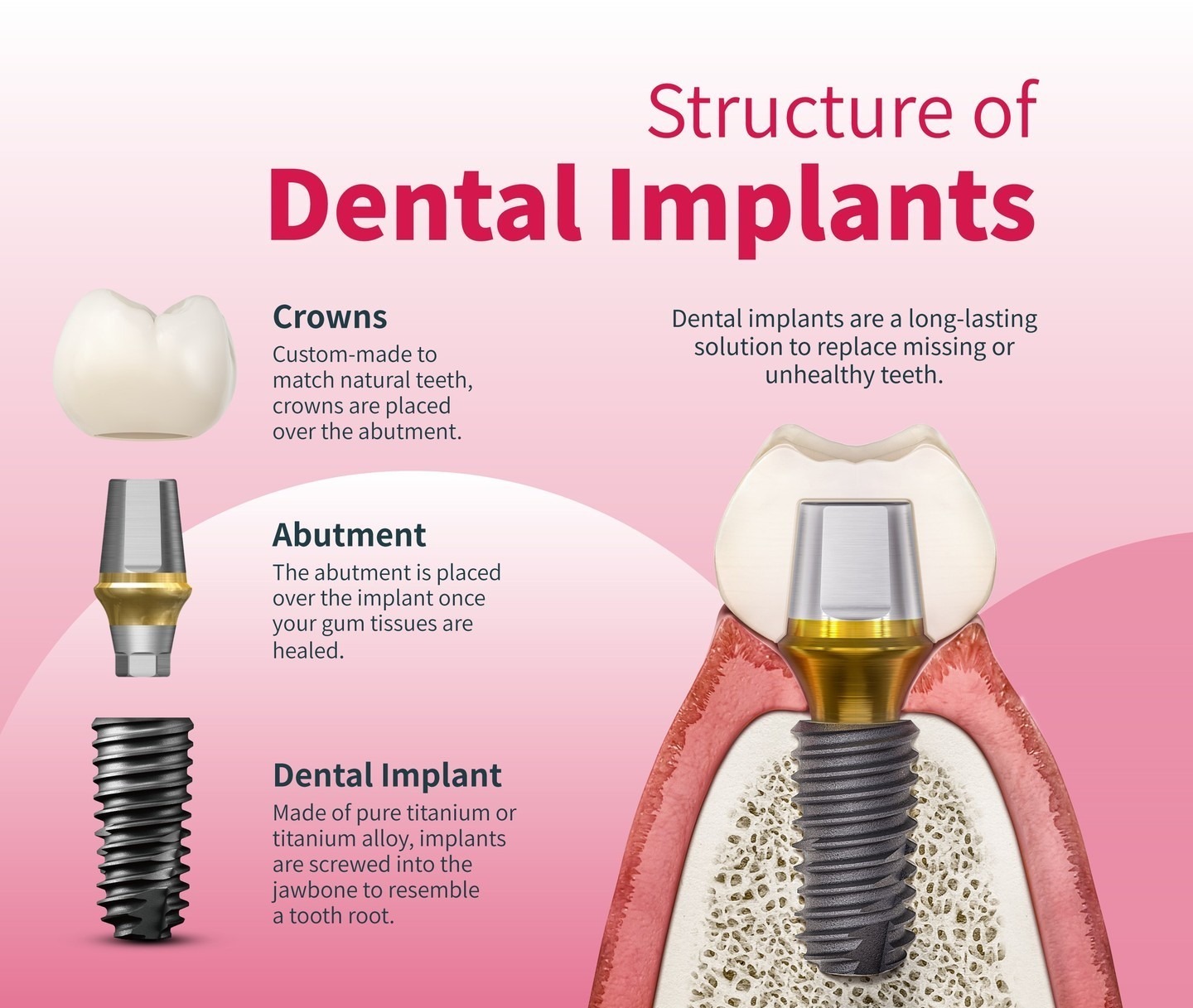 Review Tổng Quan Trụ Implant Hiossen đến Từ Mỹ