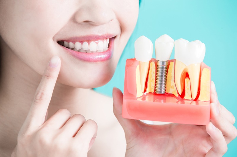 Việc lựa chọn Implant Hiossen sẽ làm tăng tỉ lệ thành công trong quá trình cấy ghép răng 