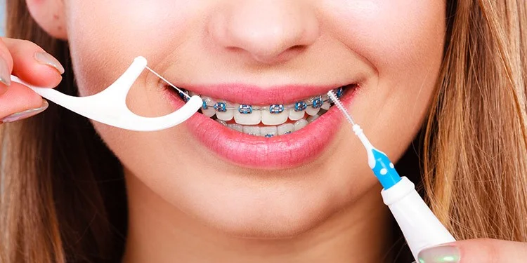 Bàn chải kẽ hiệu quả trong làm sạch kẽ răng khi niềng răng mắc cài