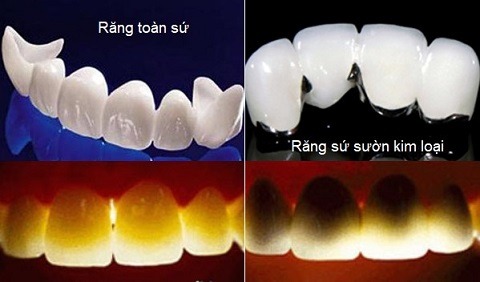 1 bộ răng sứ bao nhiêu tiền? So sánh răng toàn sứ và răng sứ kim loại dưới ánh sáng chiếu 