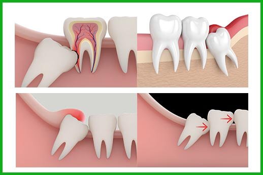 Răng khôn mọc lệch có thể gây đau đớn ảnh hưởng đến ăn uống, sinh hoạt, trong một số trường hợp cần nhổ 2 răng khôn cùng lúc