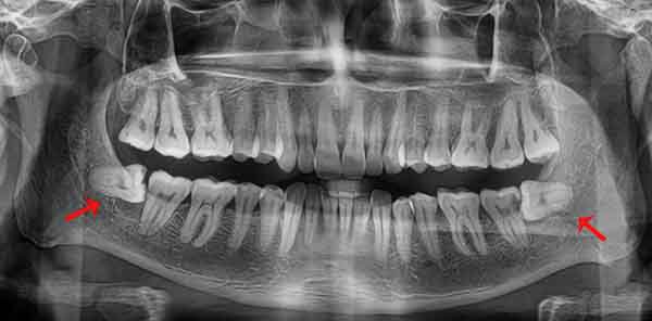 Nhổ 2 răng khôn cùng lúc, nhổ 2 răng khôn khác phía cùng 1 lúc sẽ gây khó khăn hơn trong việc chăm sóc sau nhổ