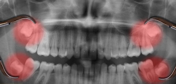 Một số trường hợp không chỉ nhổ 2 răng khôn cùng lúc, có thể nhổ 4 răng khôn cùng lúc