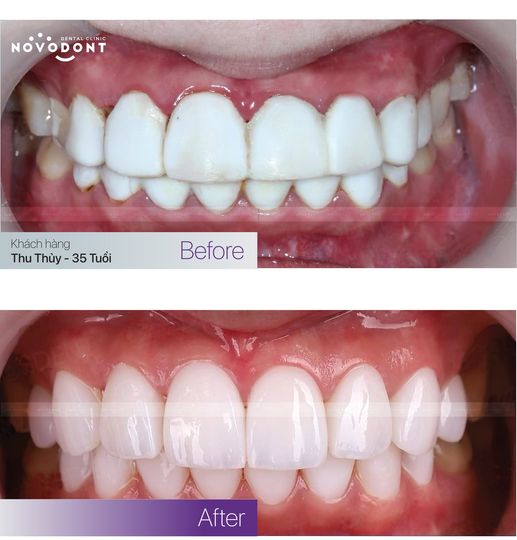 Bọc răng sứ 4 răng cửa bao nhiêu tiền? Hình ảnh trước và sau bọc răng sứ tại Nha  khoa Novodont