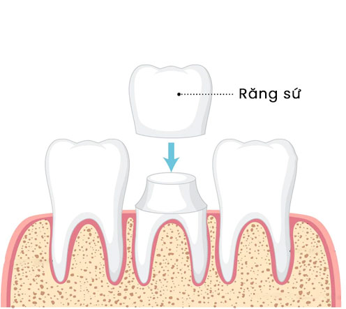 Răng sứ thẩm mỹ giúp bọc bảo vệ răng sâu, răng mẻ, răng bị khiếm khuyết