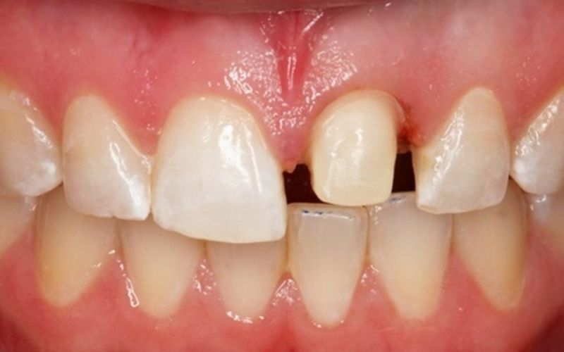 Bọc răng sứ khắc phục dễ dàng vavs trường hợp vỡ sứt mẻ răng cửa 