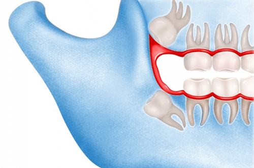 Răng khôn mọc lệch ra má gây đau kéo dài ảnh hưởng đến sức khỏe tổng thể của người bệnh 