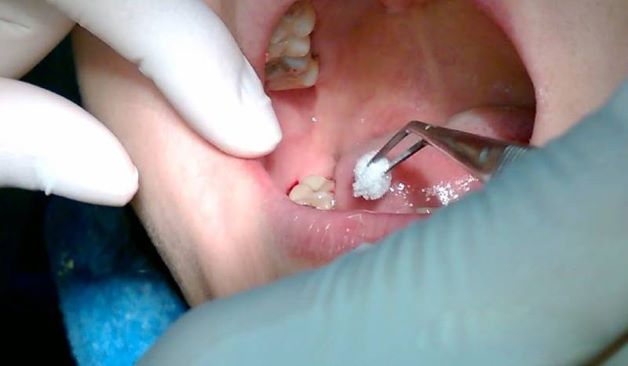 Nhận biết dấu hiệu nhiễm trùng sau khi nhổ răng khôn sớm sẽ giảm nguy cơ biến chứng 