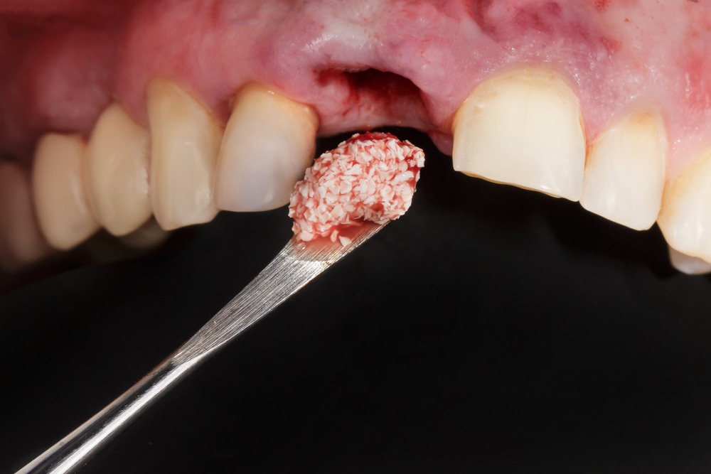 Ghép xương răng được xem là một trong những phương pháp phục hình răng hiệu quả hiện nay 
