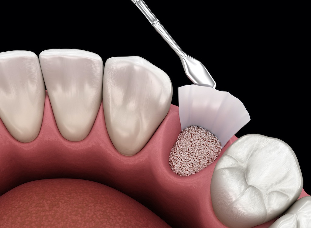 Chúng ta cần ghép xương răng nếu răng có nguy cơ không thể mọc lại