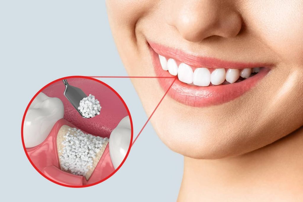 Hiện nay có bốn phương pháp ghép xương răng tiên tiến 