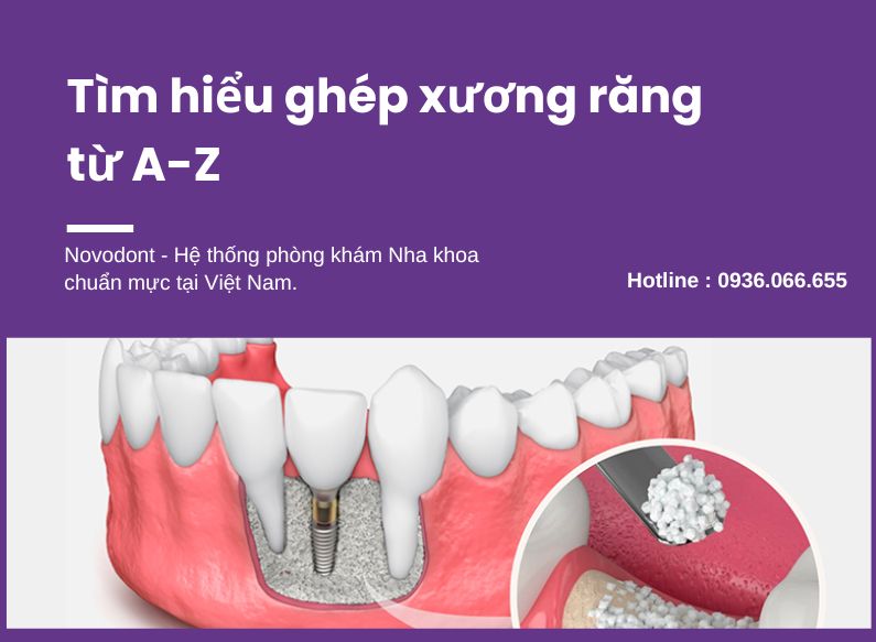 Ghép xương răng được áp dụng trong điều trị phục hình răng