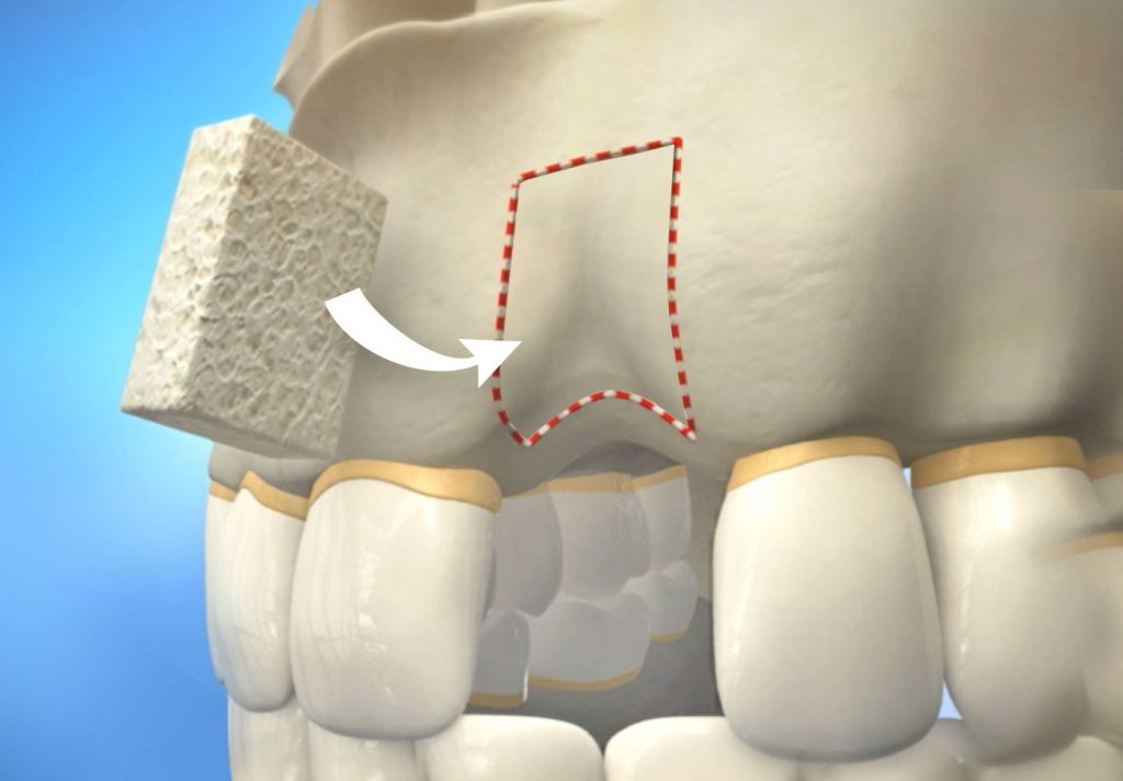Ghép xương tự thân đóng vai trò quan trọng trong việc tạo điểm tựa cho trụ Implant 