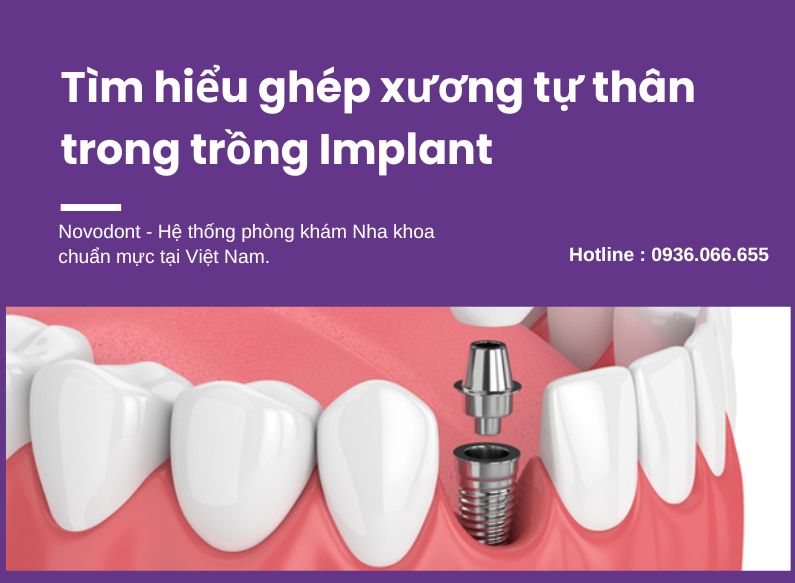 tìm hiểu về ghép xương tự thân trong trồng implant