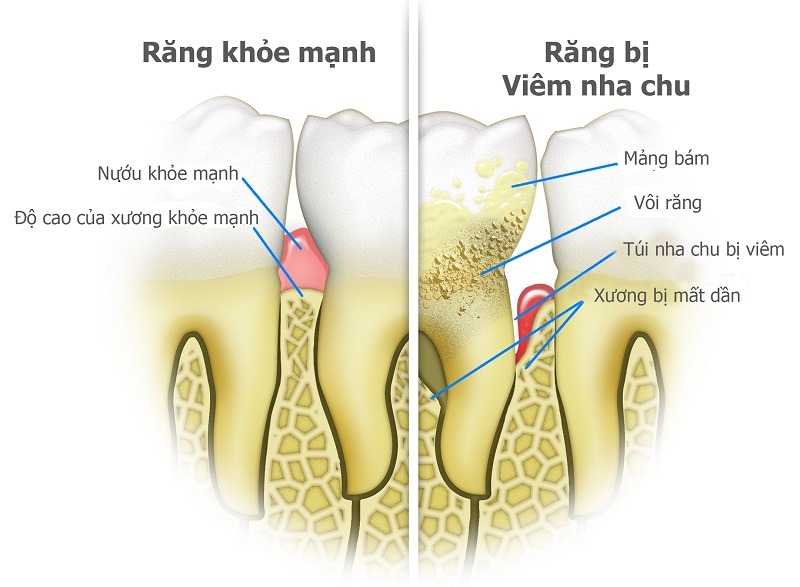 Khi nào nên trồng răng implant? Viêm nha chu có thể gây mất răng vĩnh viễn 