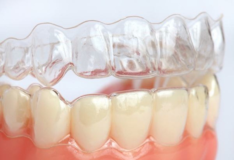 Kinh nghiệm niềng răng: Đeo hàm duy trì 20h mỗi ngày trong vài năm để đảm bảo hàm răng ổn định 