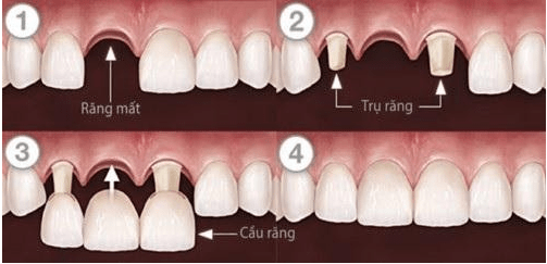 Phương pháp làm cầu răng sứ 