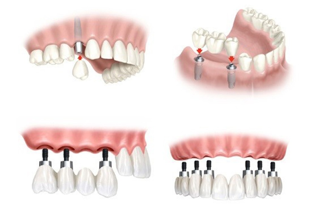 Mất răng lâu năm có trồng được implant không? Trồng răng implant phù hợp với mọi tình trạng mất răng