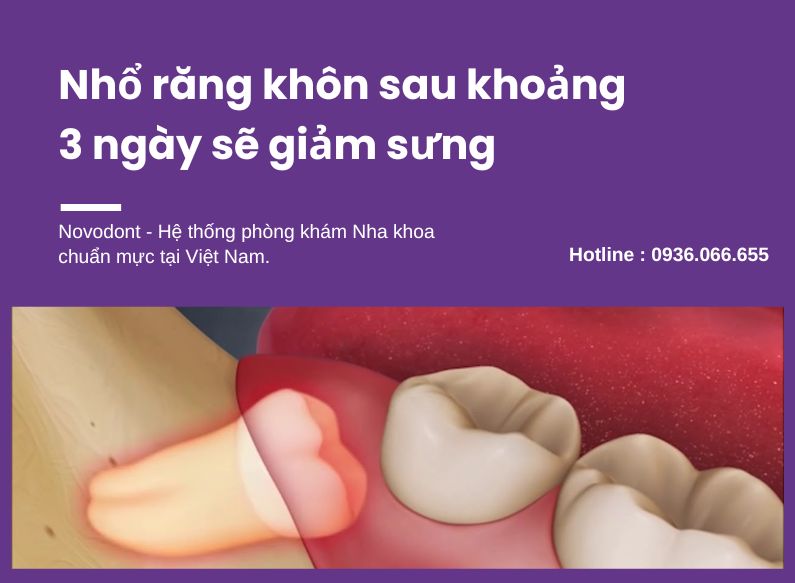 Nhổ răng khôn bao lâu thì lành?